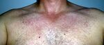 Hiv Symptome Hautausschlag Bilder : Ringelroteln Erythema In